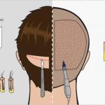 FUE metoda vs FUT transplantacija kose